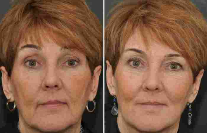 Cost of Fillers_ What to Expect