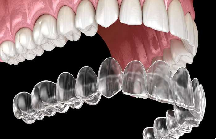 aligner